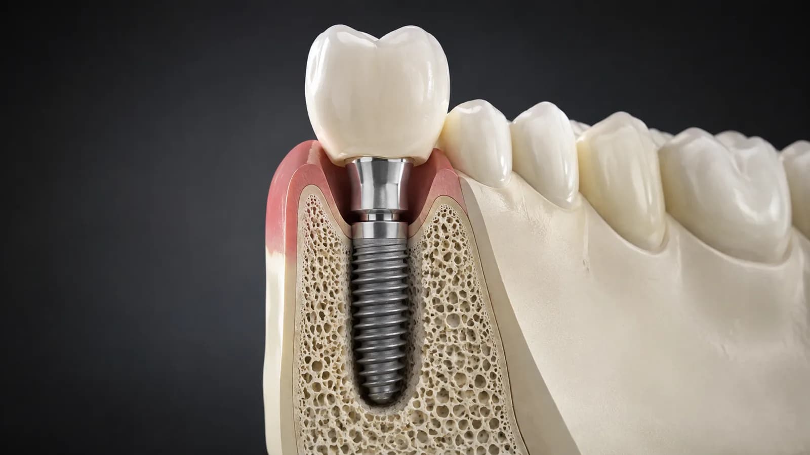 Cutaway illustration of a dental implant and ceramic crown